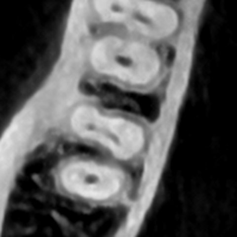 DVT Schnittbild Zahn 47