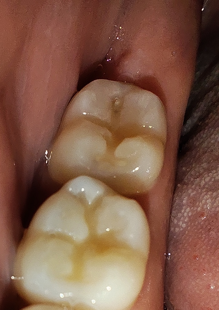 Intraoralstatus 25.01.2026